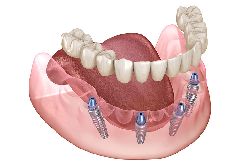 All on 4 Dental Implants in El Paso