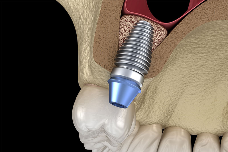 Bone Augmentation in El Paso