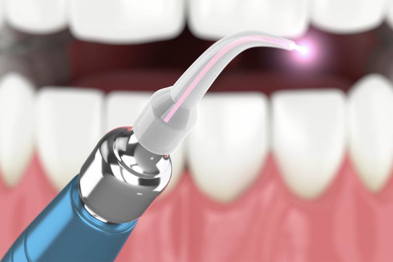 Laser Periodontal Therapy in El Paso