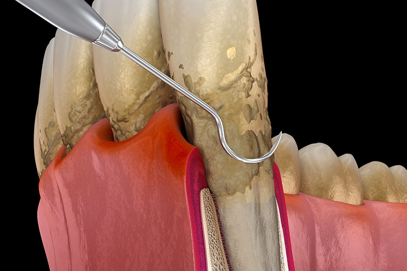 Periodontal Therapy in El Paso