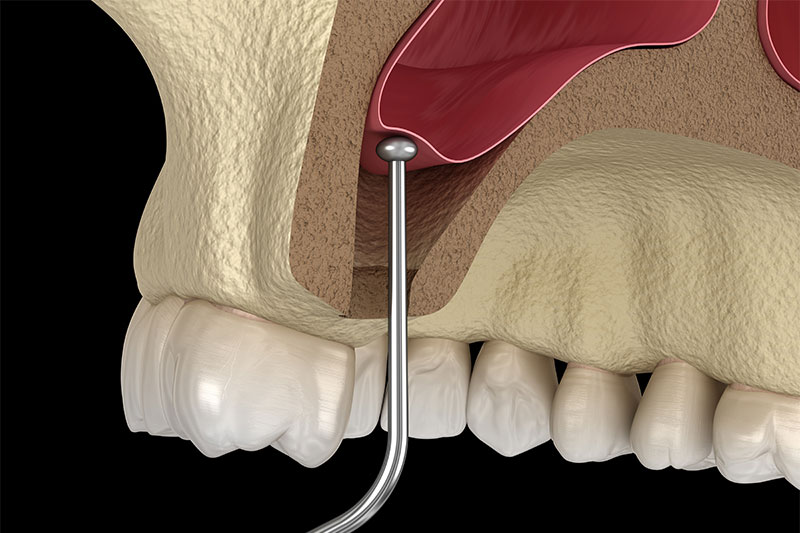 Sinus Augmentation in El Paso