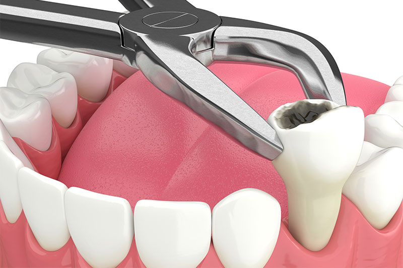 Tooth Extraction in El Paso